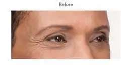 Botox Before & After Patient #707