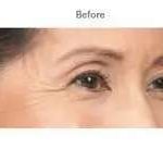 Botox Before & After Patient #710