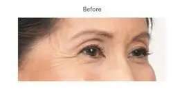 Botox Before & After Patient #710