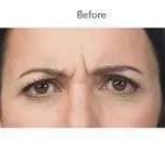 Botox Before & After Patient #713