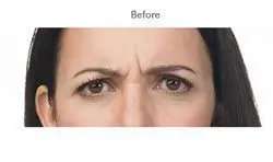 Botox Before & After Patient #713