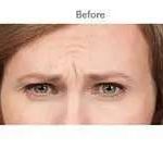 Botox Before & After Patient #716