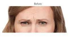 Botox Before & After Patient #716