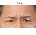 Botox Before & After Patient #719
