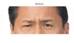 Botox Before & After Patient #719