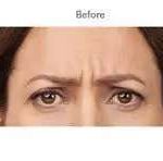 Botox Before & After Patient #722