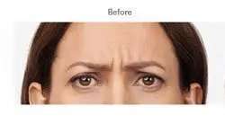 Botox Before & After Patient #722