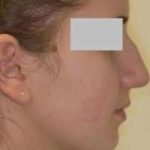 Rhinoplasty Before & After Patient #75