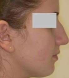 Rhinoplasty Before & After Patient #75