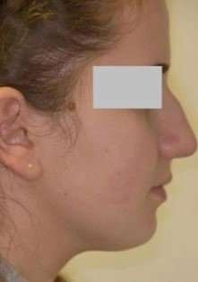 Rhinoplasty Before & After Patient #75