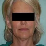 Face Neck Lift Before & After Patient #137