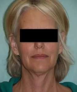 Face Neck Lift Before & After Patient #137