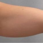 Smartlipo Vaser Lipo Before & After Patient #478