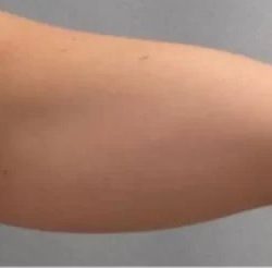 Smartlipo Vaser Lipo Before & After Patient #478