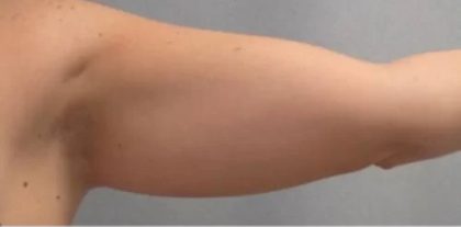 Smartlipo Vaser Lipo Before & After Patient #478