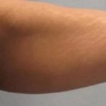 Smartlipo Vaser Lipo Before & After Patient #483