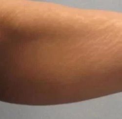 Smartlipo Vaser Lipo Before & After Patient #483