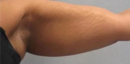 Smartlipo Vaser Lipo Before & After Patient #483
