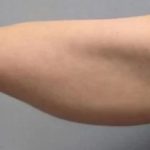 Smartlipo Vaser Lipo Before & After Patient #491