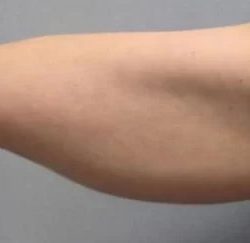 Smartlipo Vaser Lipo Before & After Patient #491