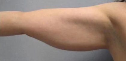 Smartlipo Vaser Lipo Before & After Patient #491