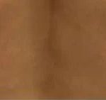 Smartlipo Vaser Lipo Before & After Patient #564
