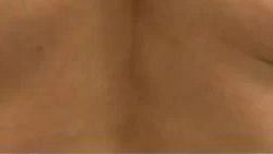 Smartlipo Vaser Lipo Before & After Patient #564