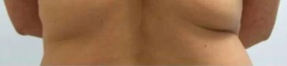 Smartlipo Vaser Lipo Before & After Patient #564