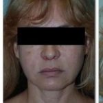 Face Neck Lift Before & After Patient #140