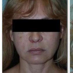Face Neck Lift Before & After Patient #140