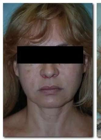 Face Neck Lift Before & After Patient #140