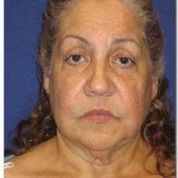 Face Neck Lift Before & After Patient #143