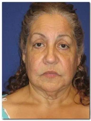 Face Neck Lift Before & After Patient #143