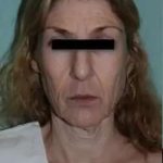 Face Neck Lift Before & After Patient #146
