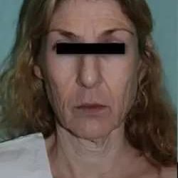 Face Neck Lift Before & After Patient #146