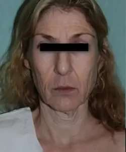 Face Neck Lift Before & After Patient #146
