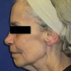 Face Neck Lift Before & After Patient #149