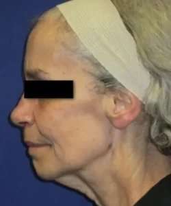 Face Neck Lift Before & After Patient #149