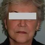 Face Neck Lift Before & After Patient #152