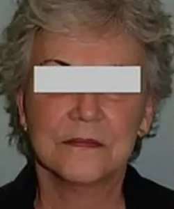 Face Neck Lift Before & After Patient #152
