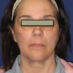 Face Neck Lift Before & After Patient #155