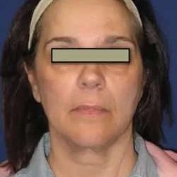 Face Neck Lift Before & After Patient #155