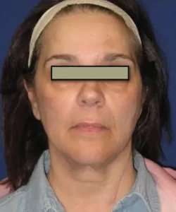 Face Neck Lift Before & After Patient #155