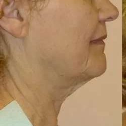 Face Neck Lift Before & After Patient #158