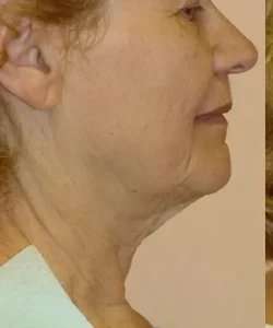 Face Neck Lift Before & After Patient #158