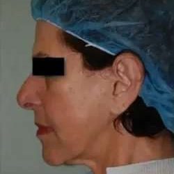Face Neck Lift Before & After Patient #161