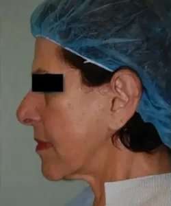 Face Neck Lift Before & After Patient #161