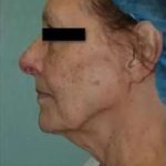 Face Neck Lift Before & After Patient #164