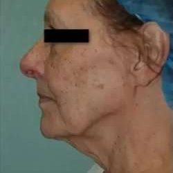 Face Neck Lift Before & After Patient #164