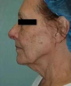 Face Neck Lift Before & After Patient #164